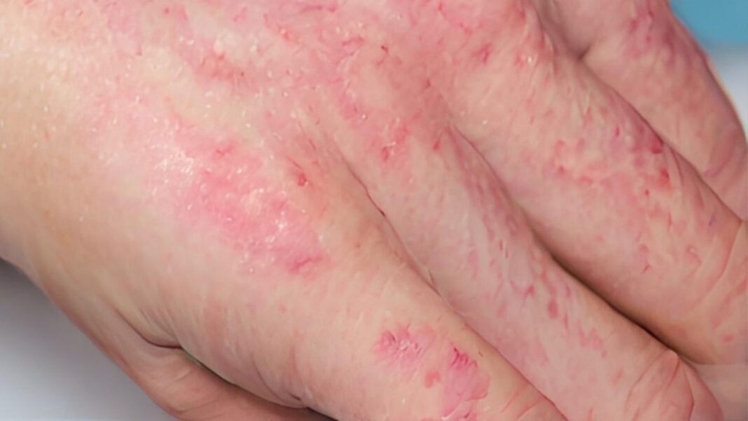 Dermatitis Atópica